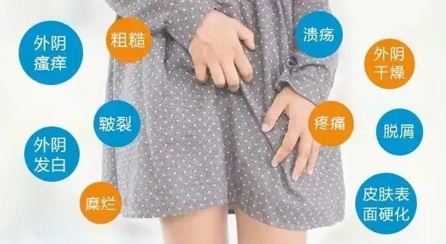 外阴白斑患者该怎么护理？