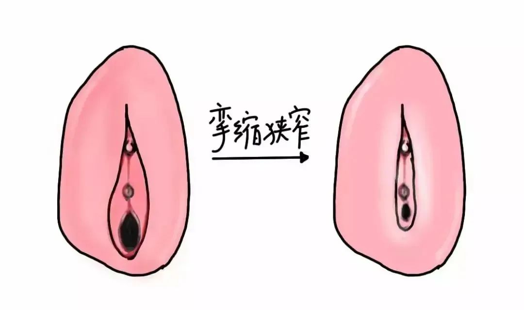 患上外阴白斑病后外阴皮肤颜色一定会变白吗？