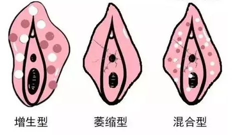 外阴白斑有哪些类型？