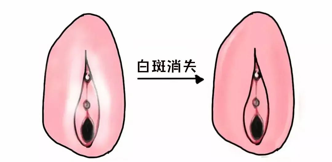 外阴白斑治愈的标准