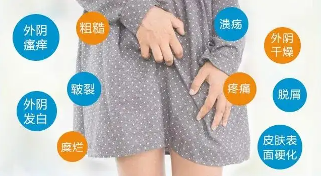 外阴白斑的症状有哪些